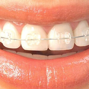 ortodontia-aparelho-ceramico-BANNER-dra-jessica-araujo-dentista-SJP-CURITIBA-04 ortodontia-aparelho-ceramico-BANNER-dra-jessica-araujo-dentista-SJP-CURITIBA-04