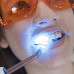 CLAREAMENTO-DENTAL-dra-jessica-araujo-dentista-SJP-CURITIBA-ARAUJO-ODONTOLOGIA-foto-01 CLAREAMENTO-DENTAL-dra-jessica-araujo-dentista-SJP-CURITIBA-ARAUJO-ODONTOLOGIA-foto-01